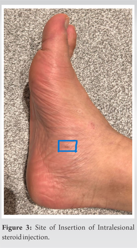 A Rare Case of Hallux Saltans Treated using Ultrasound-guided ...