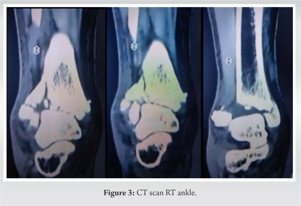 Case Report: A Rare Case Of Bilateral Tibial Plafond Fracture In A ...