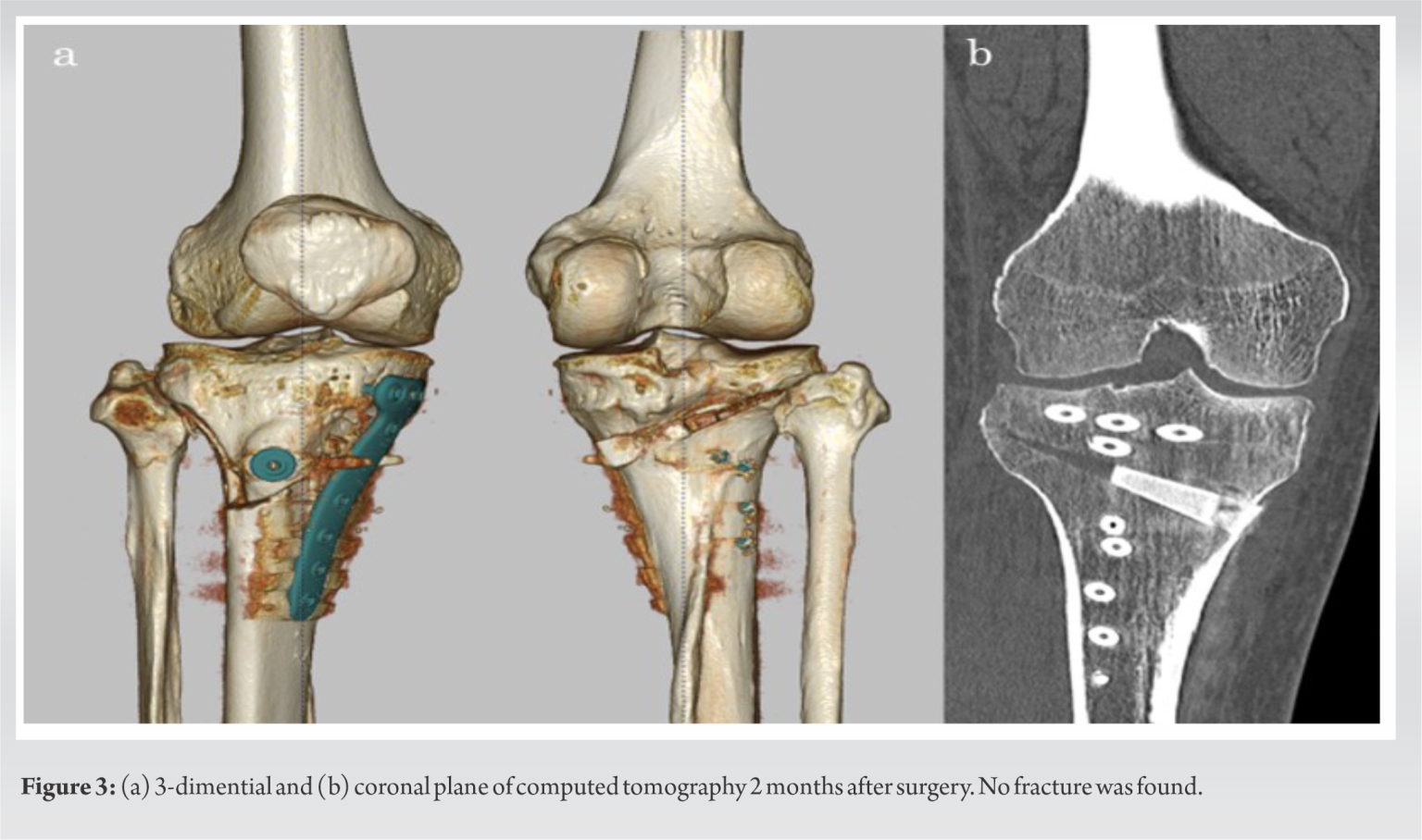 Posterior Aspect Fracture of Tibia after Open Wedge Distal Tuberosity ...