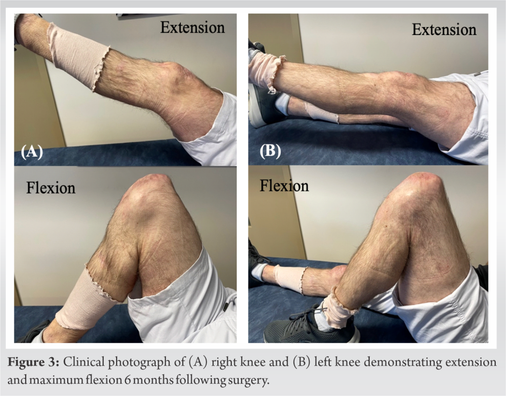 Spontaneous Bilateral Patellar Tendon Rupture in Patient with Ehlers ...