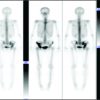 Primary Lymphoma of the Pelvis: A Case Report