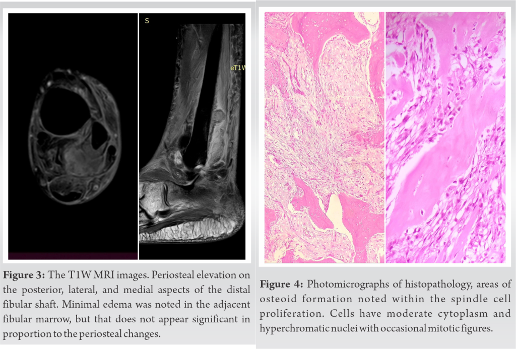 Periosteal Osteosarcoma Of The Distal Shaft Of Fibula Case Report On