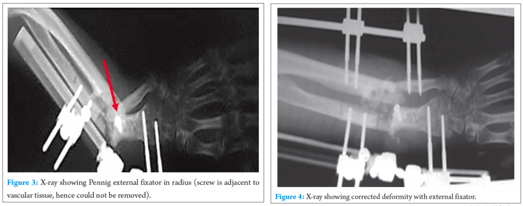 Modified Boyd’s Dual Onlay Bone Graft Technique for 15 Years Old ...