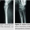 A Pediatric Floating Elbow Associating Flexion Type Supracondylar Fracture with Both Bone Forearm Fracture And Ulnar Nerve Irritation: A Case Report