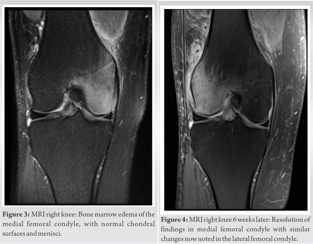 Regional Migratory Osteoporosis – A Rare Cause of Knee Pain (Case ...