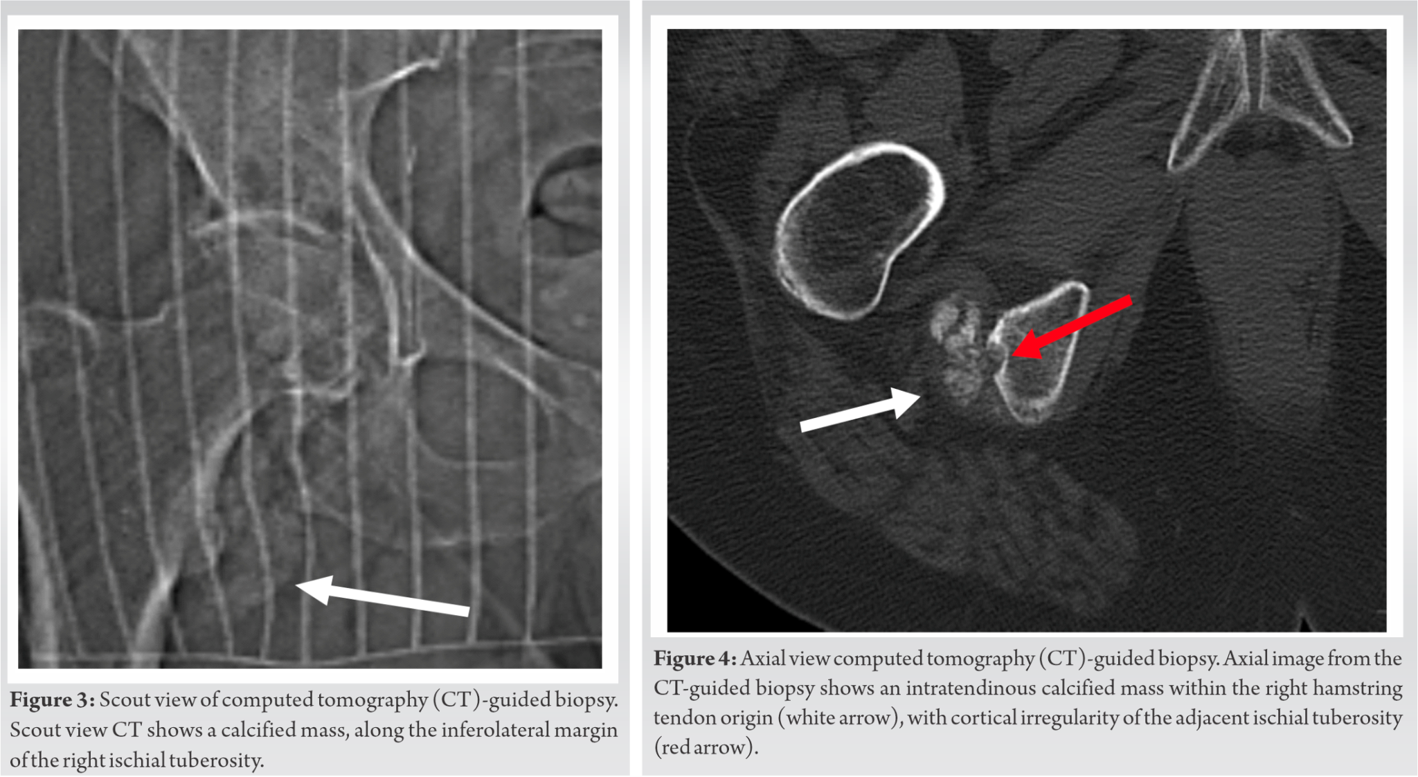 Intratendinous Calcified Chondroid Mesenchymal Neoplasm: A Case Report ...