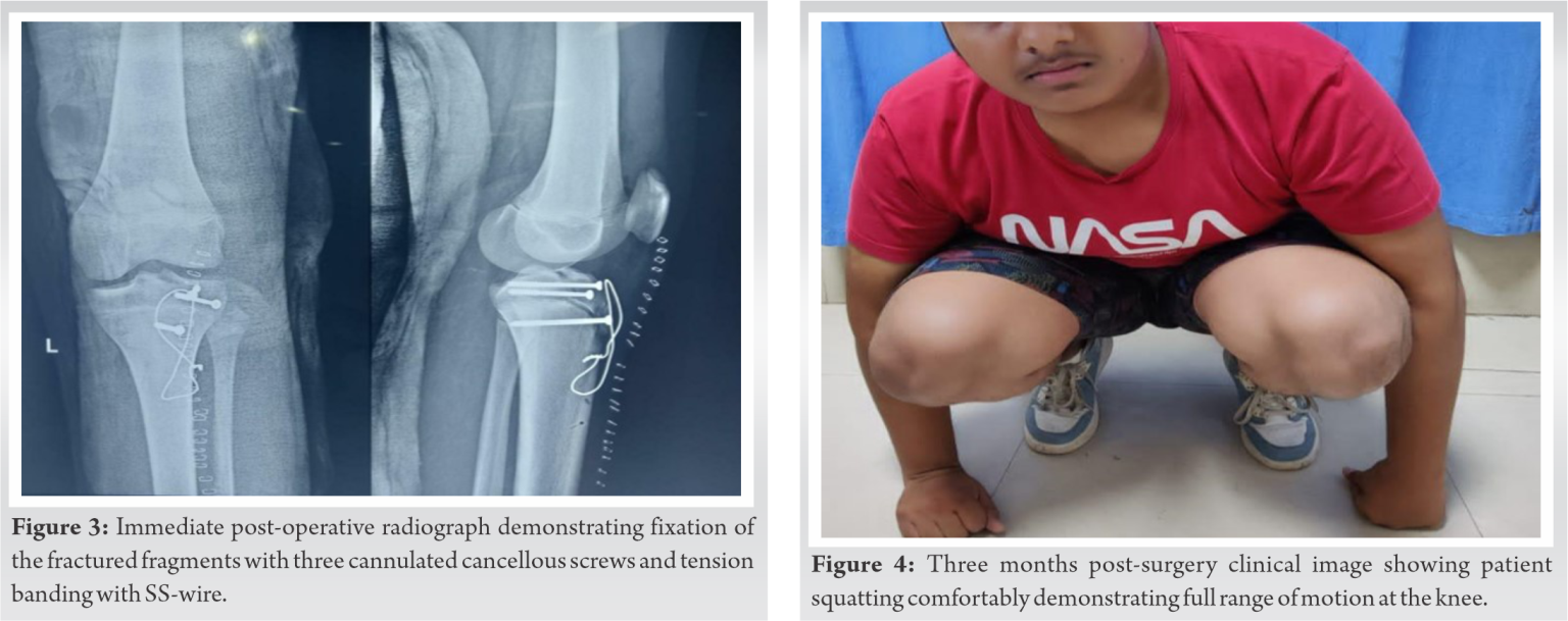 Tibial Tuberosity Avulsion Fracture with Epiphyseal Injury in a Soccer ...