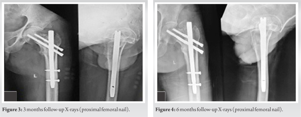 Comparison of functional and radiological outcome of unstable ...