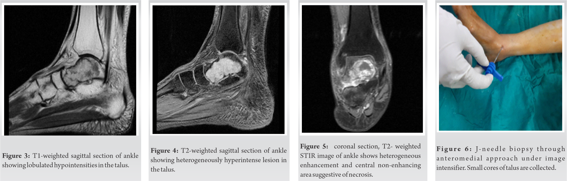 fig-3-4-5-6-journal-of-orthopaedic-case-reports