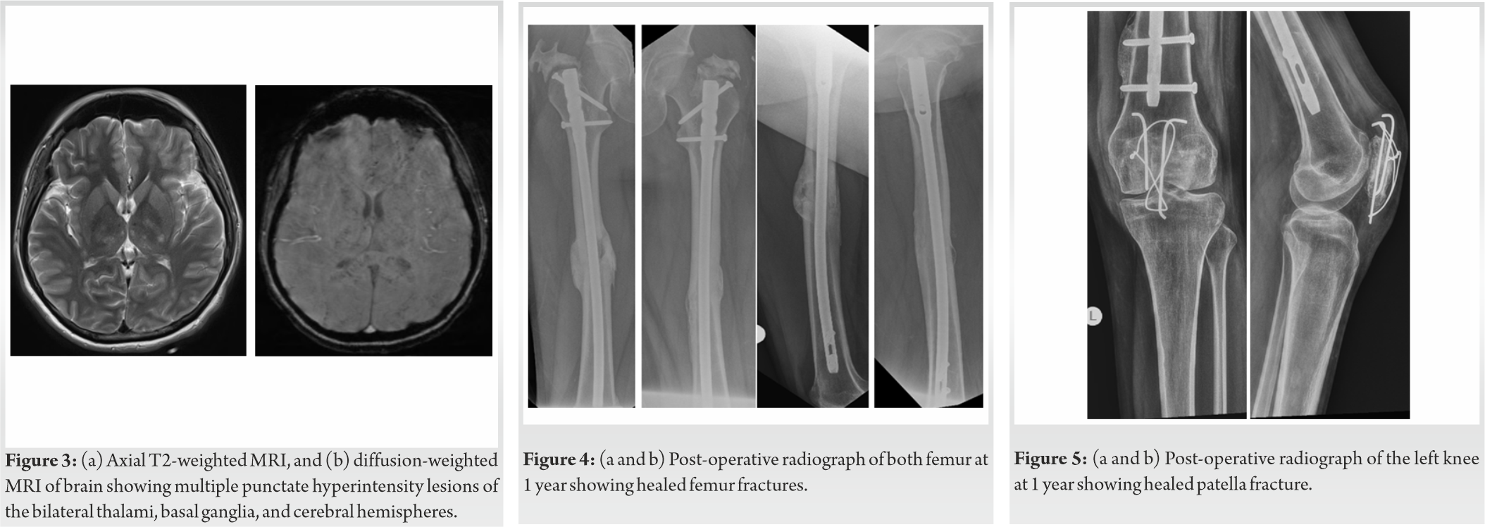 Fig 3 4 5 Journal Of Orthopaedic Case Reports