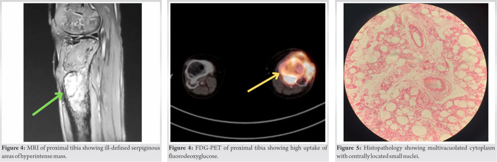 fig-3-4-5-journal-of-orthopaedic-case-reports