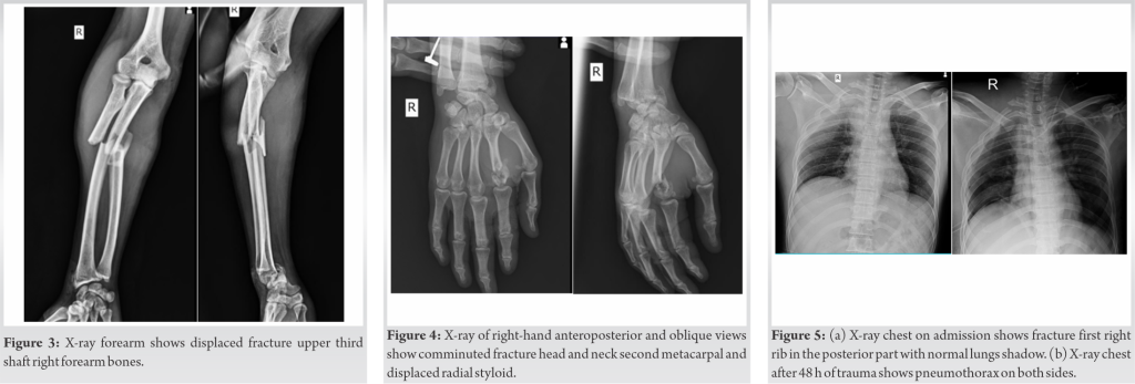 fig-3-4-5-journal-of-orthopaedic-case-reports