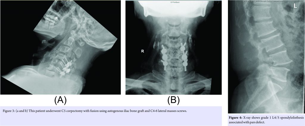 Unusual Presentation Of Spinal Gout: 2 Cases Report And Literature 