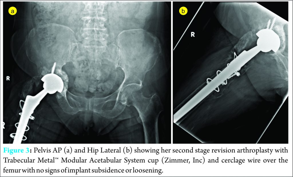 Acetabular Prosthetic Protrusio After Bipolar Hemi-Arthroplasty Of The ...