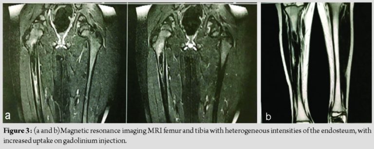 Melorheostosis in an Adolescent with Limb Length Discrepancy and ...