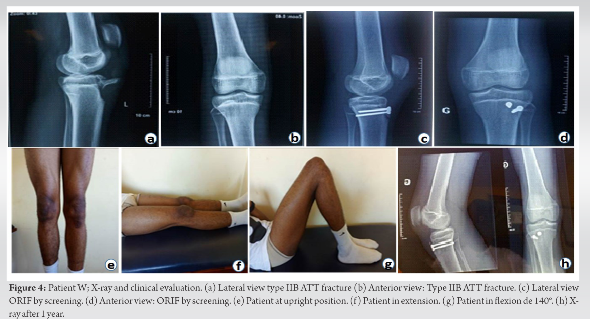 Tibial Tubercle Avulsion Fractures in Adolescence in Sports Injury ...