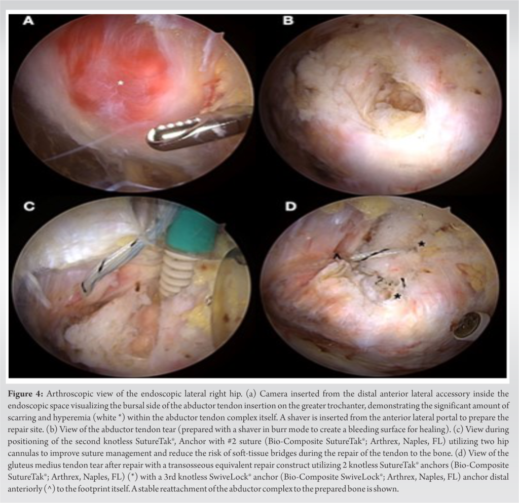 Endoscopic Repair Of Hip Abductor Tendon Tears A Case Report Journal Of Orthopaedic Case Reports 3749