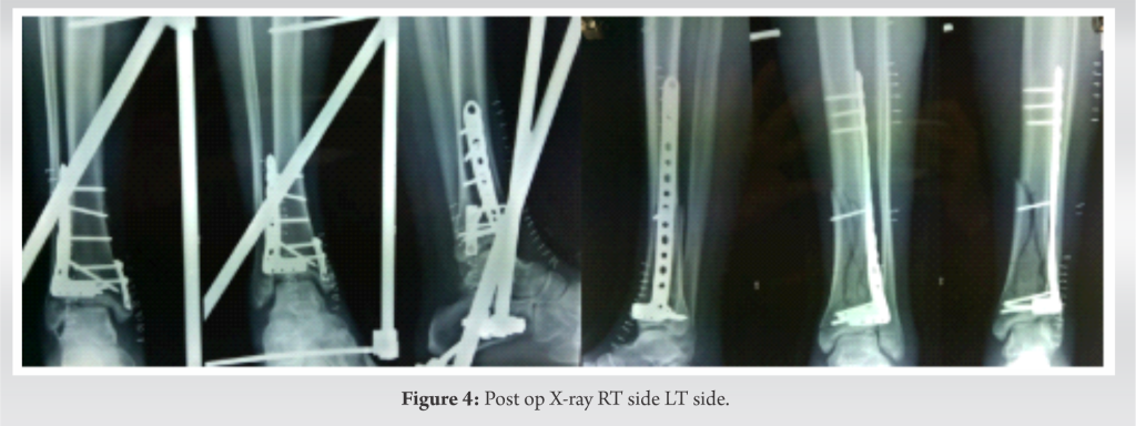 Case Report: A Rare Case Of Bilateral Tibial Plafond Fracture In A ...