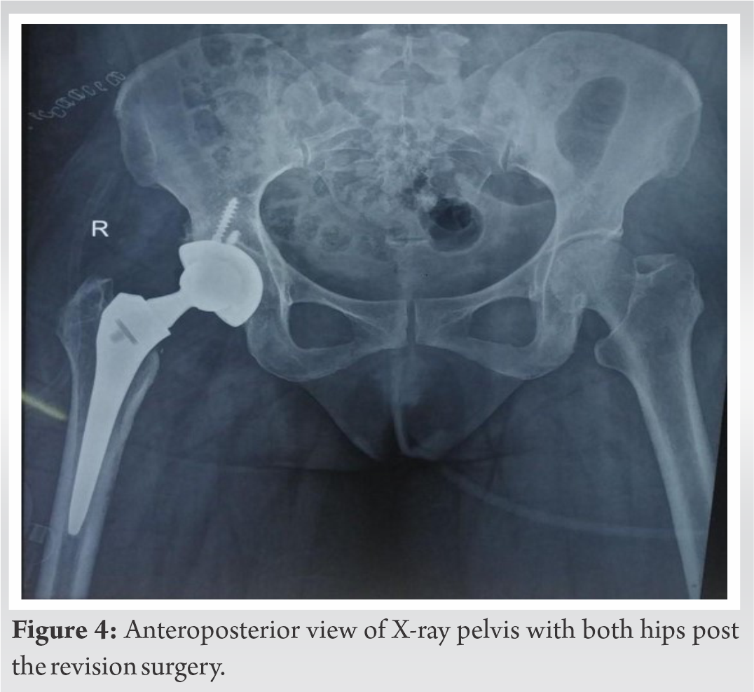Metallosis Following Non-Metal-on-Metal Hip Arthroplasty: A Case Report ...