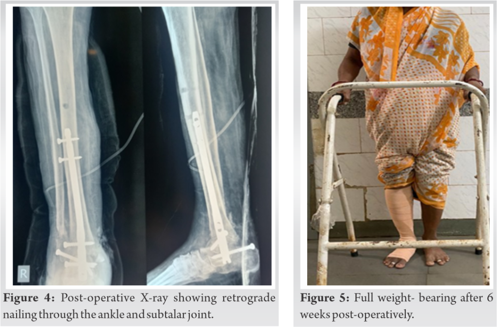 fig-4-5-journal-of-orthopaedic-case-reports