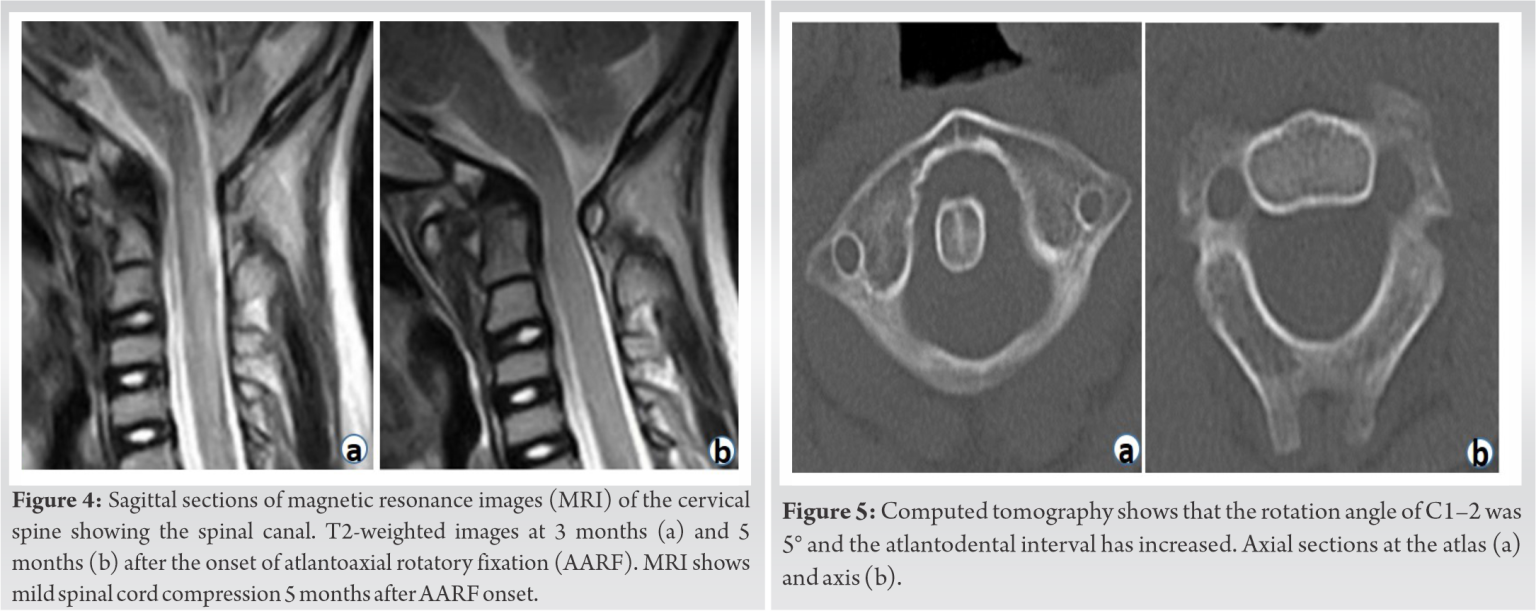 Atlantoaxial Instability after Treatment of Atlantoaxial Rotatory ...