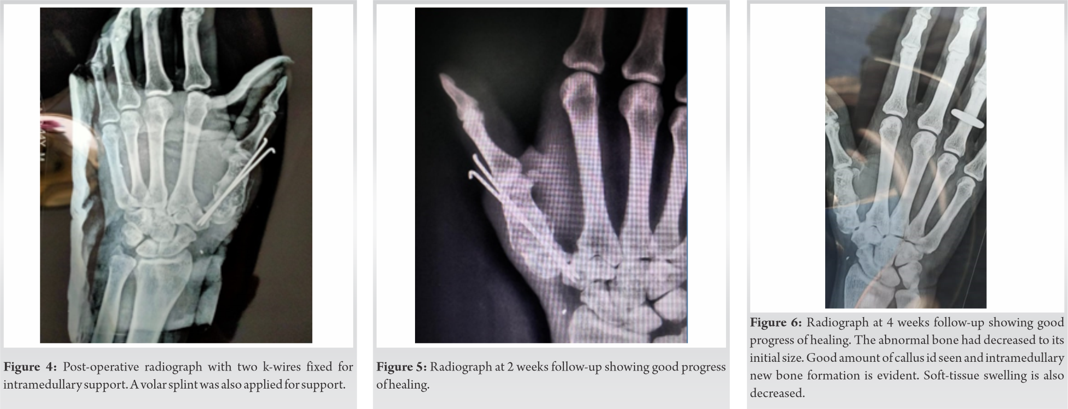 Fig 4 5 6 | Journal of Orthopaedic Case Reports