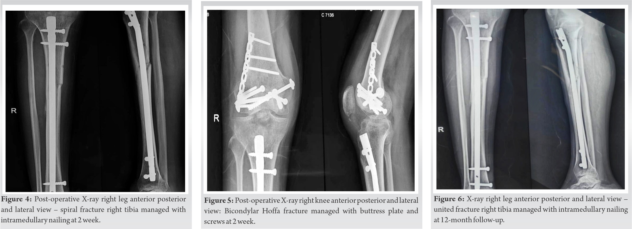 Fig 4 5 6 | Journal of Orthopaedic Case Reports