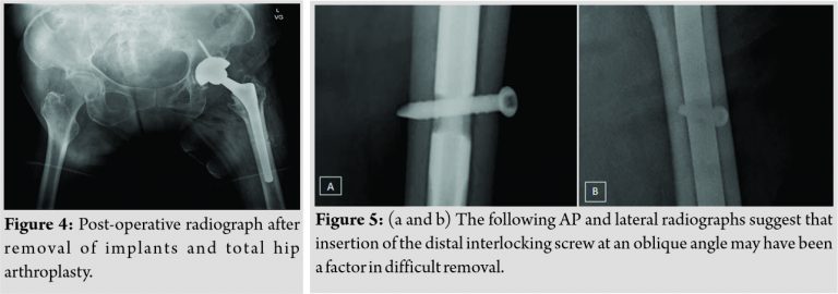 A Simple Technique for Removal of Interlocking Screw from an ...