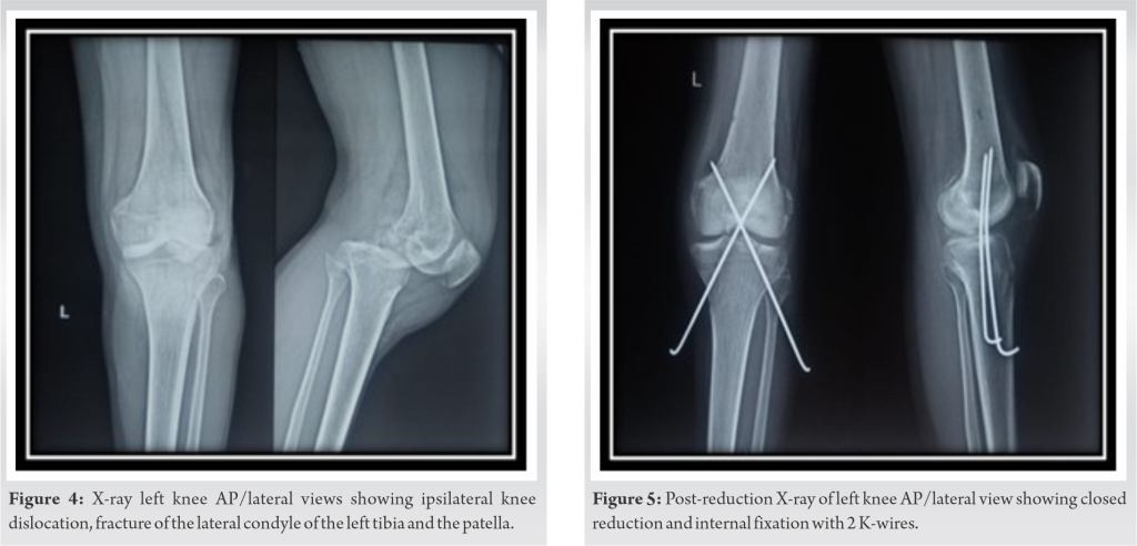 From Trauma to Triumph: Navigating the Complexities of a Central Hip ...