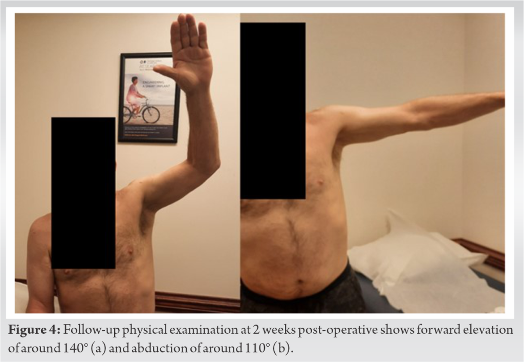 Effective Management Of Bilateral Massive Irreparable Rotator Cuff Tears Through Implantation Of