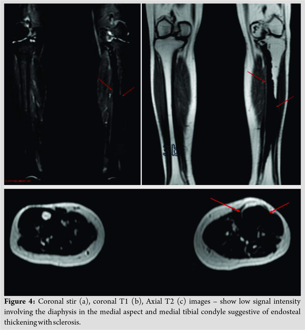 Fig 4 | Journal of Orthopaedic Case Reports