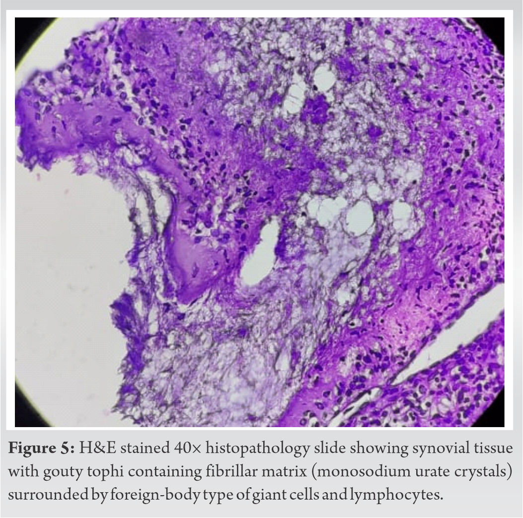 Excisional Debridement