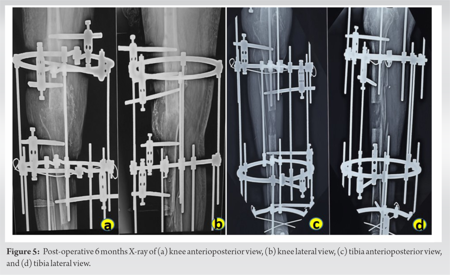 Case Of Infected Non-Union Of Distal Femur Treated With Ilizarov ...