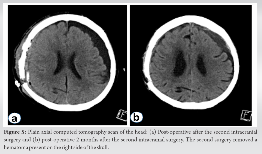 A Case Of Remote Cerebellar Hemorrhage In Spinal Surgery Without Dural Injury Case Report