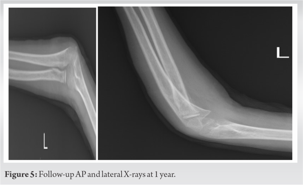 Delayed Presenting Radial Neck Epiphysiolysis Managed with Open ...