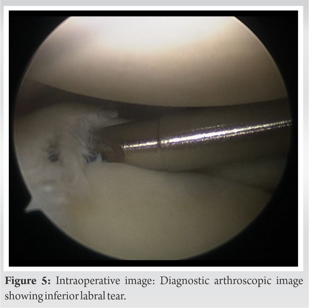 Comprehensive Evaluation and Arthroscopic Management of Circumferential ...