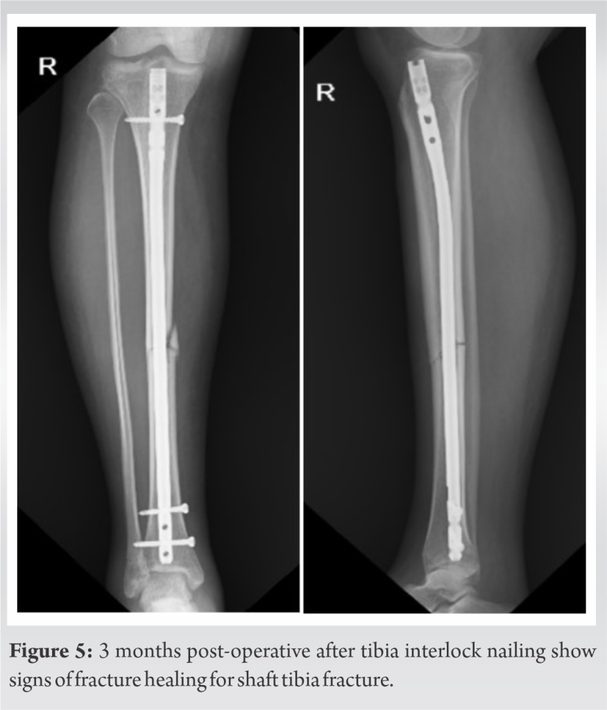 DVT with Pulmonary Embolism in Patient with Grade 2 Compound Tibia ...