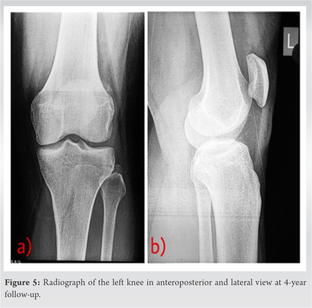 Extensive Synovial Chondromatosis of the Knee Managed by open radical ...