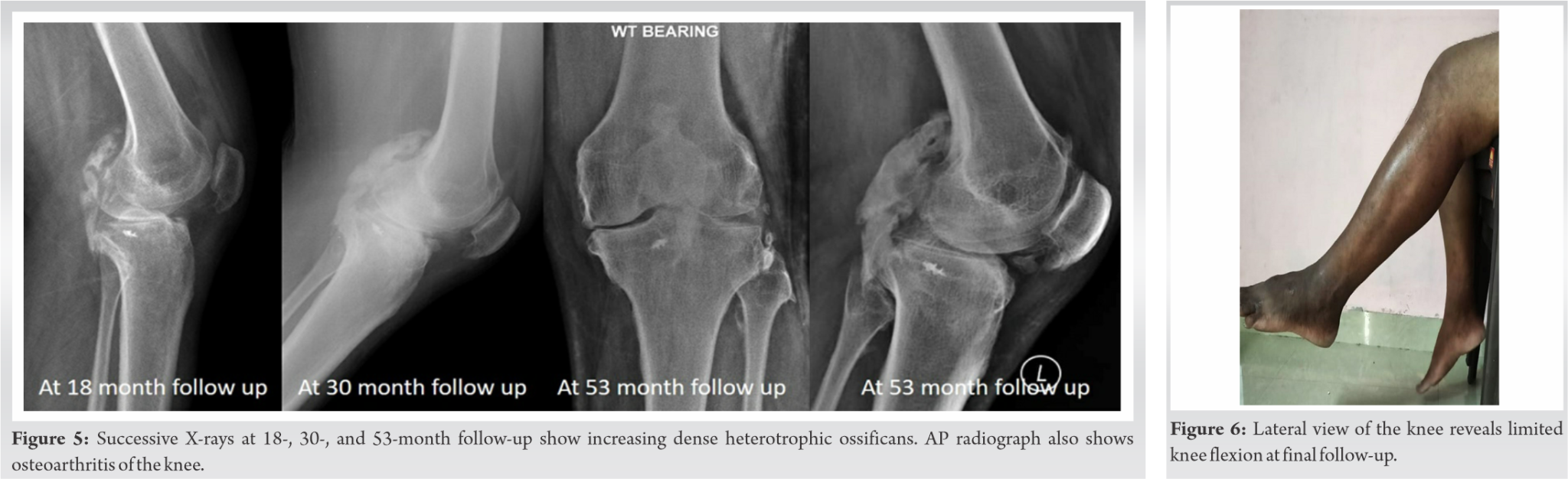 fig-5-6-journal-of-orthopaedic-case-reports