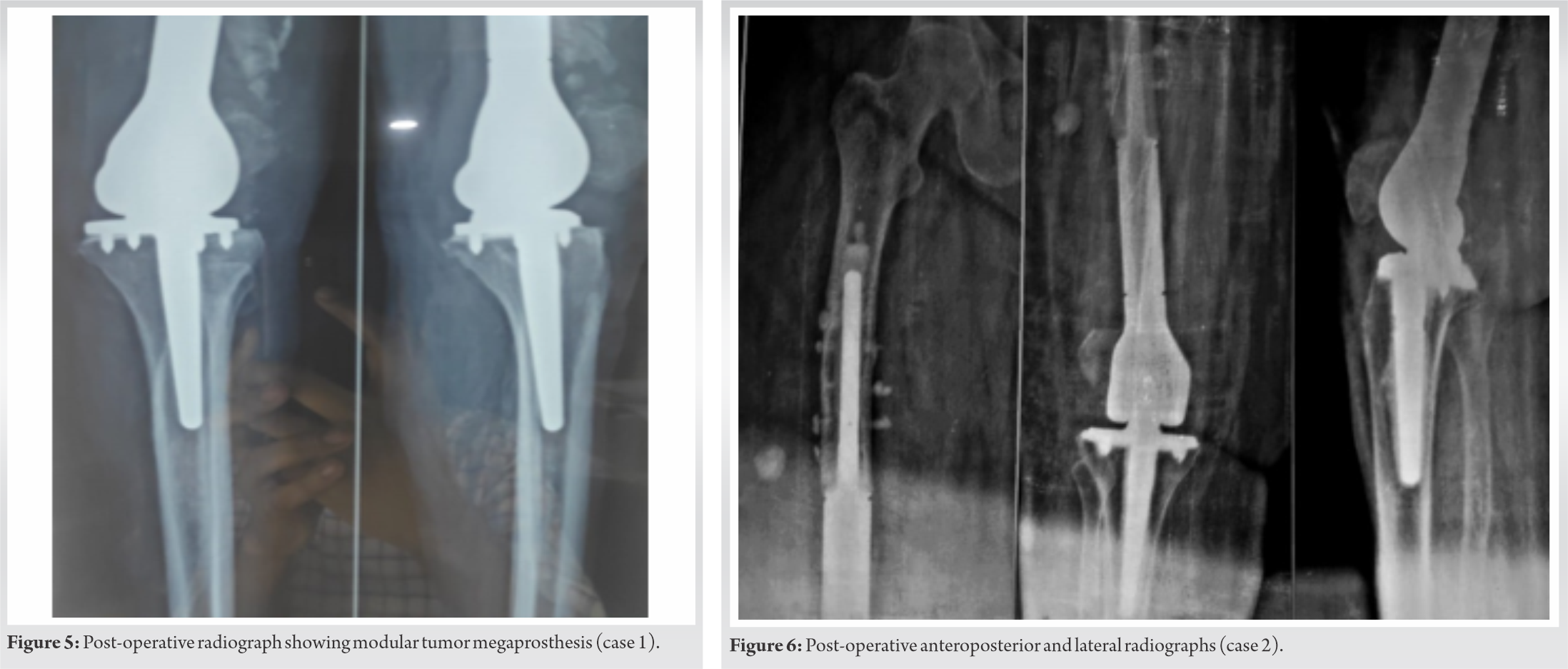 fig-5-6-journal-of-orthopaedic-case-reports