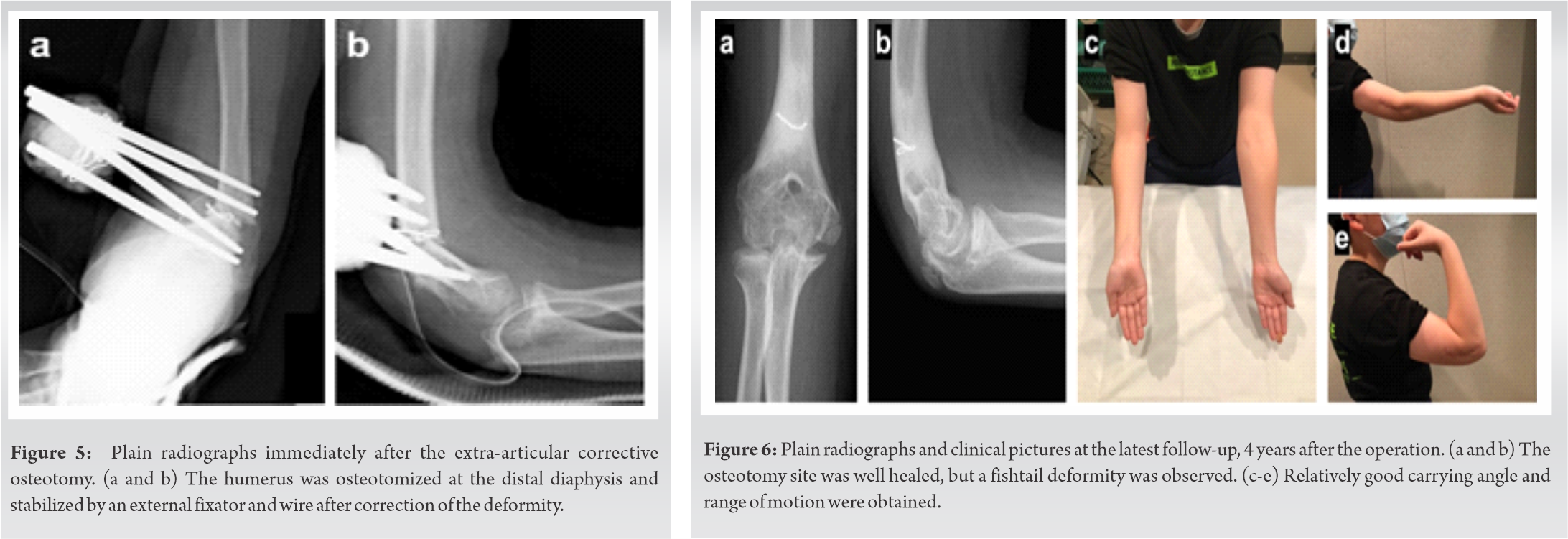 fig-5-6-journal-of-orthopaedic-case-reports