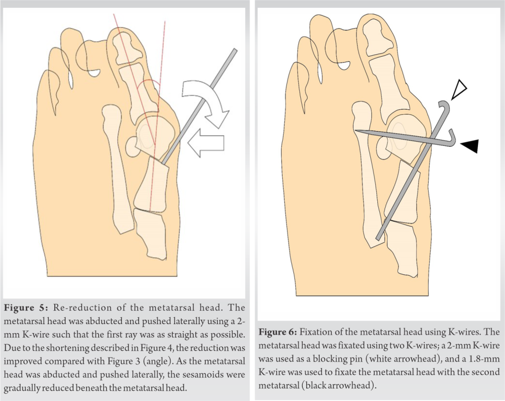 Toe Base Resection Distal Metatarsal and Proximal Phalangeal Osteotomies without Soft ...
