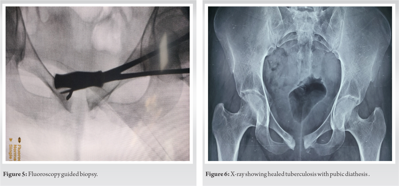 Pubic Symphysis Tuberculosis Recurrence A Rare Case Report And Literature Review Journal Of