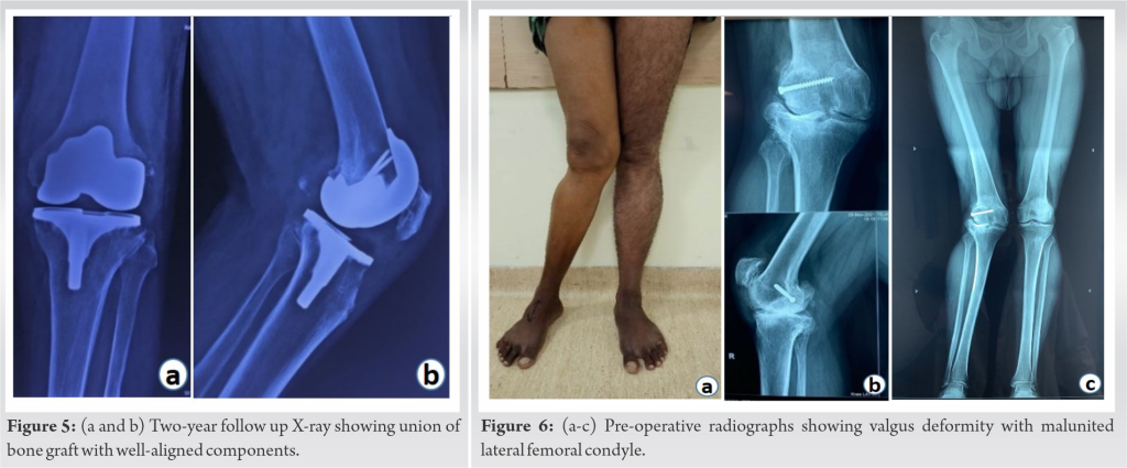 Management of Lateral Femoral Condyle Non-union with Autogenous Bone ...