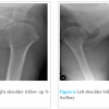 A Case of Bilateral Anterior Gleno-Humeral Dislocation following First Time Seizure