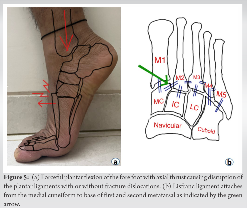 Six-week Old Neglected Homolateral Lisfranc Injury – A Case Report 