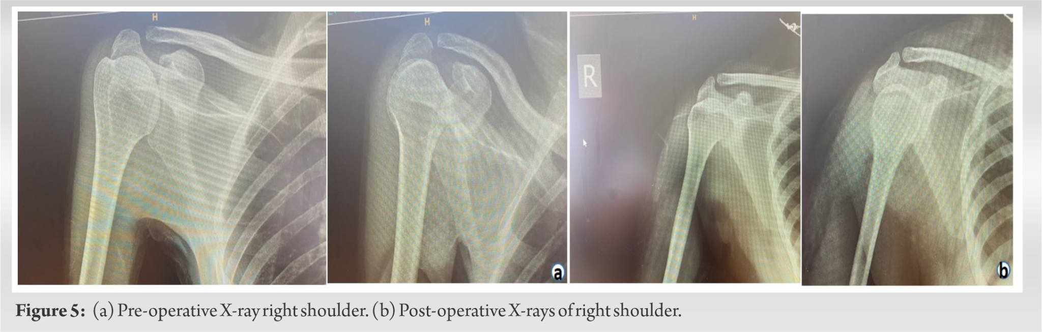Percutaneous Capsule Release in Adhesive Capsulitis with Nanoscope under Local Anesthesia Case