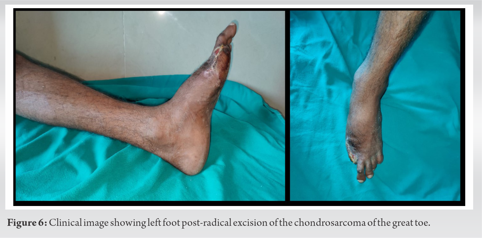 chondrosarcoma-of-great-toe-a-case-report-journal-of-orthopaedic