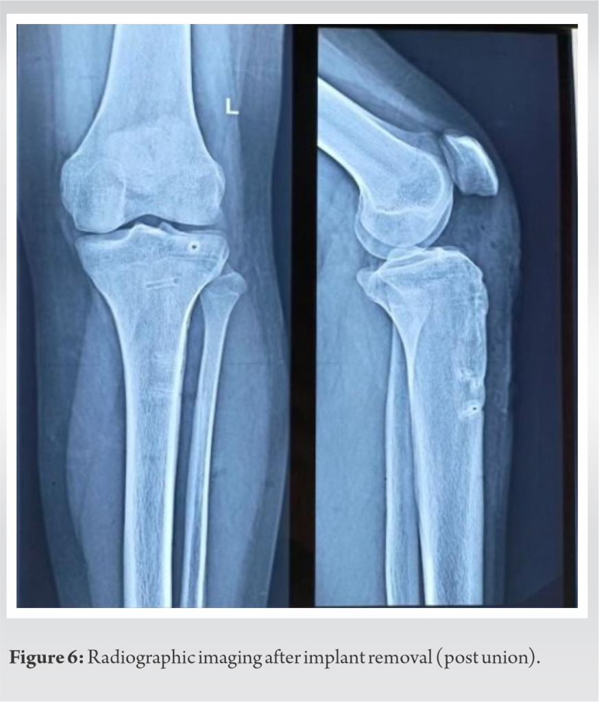 Tibial Tuberosity Avulsion Fracture with Epiphyseal Injury in a Soccer ...