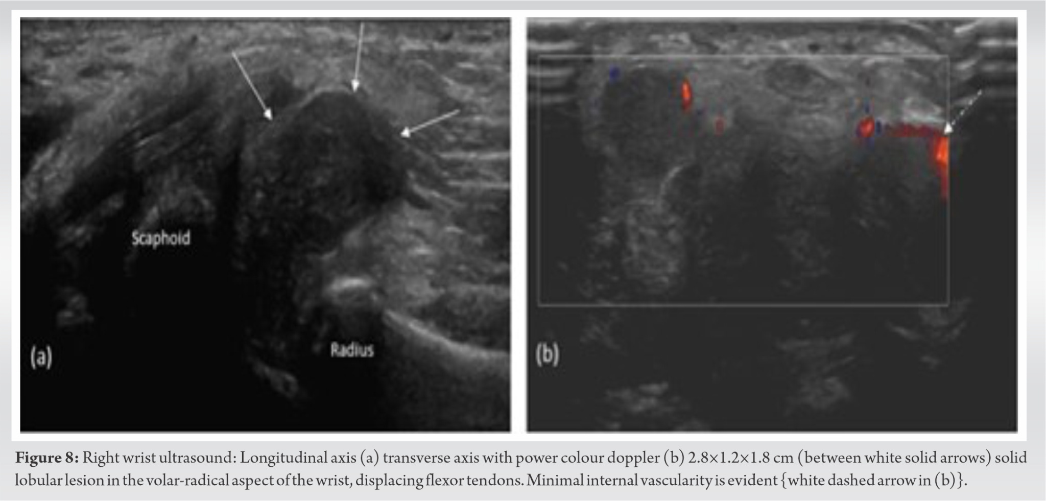 Secondary Chondrosarcoma Arising in Synovial Chondromatosis of Wrist ...